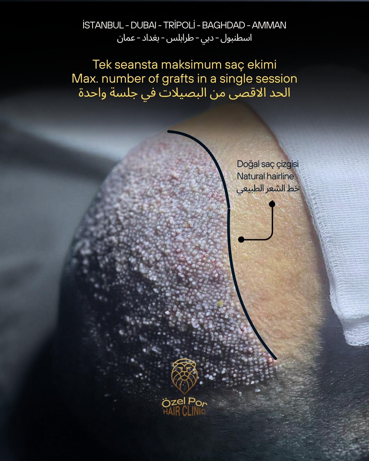 POR Hair Clinic — saç ekimi operasyonu
