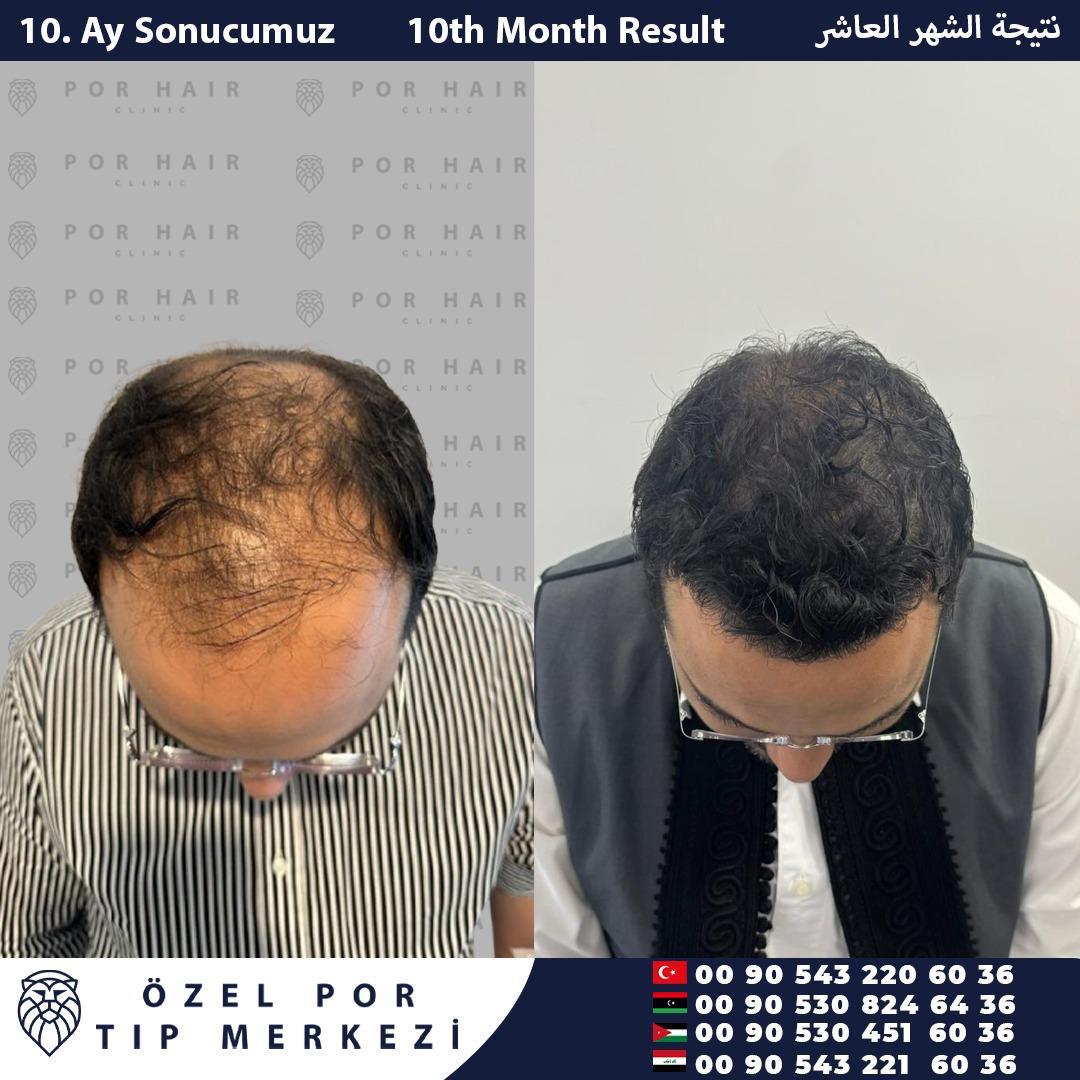 POR Hair Clinic Instagram - saç ekimi paylaşımları