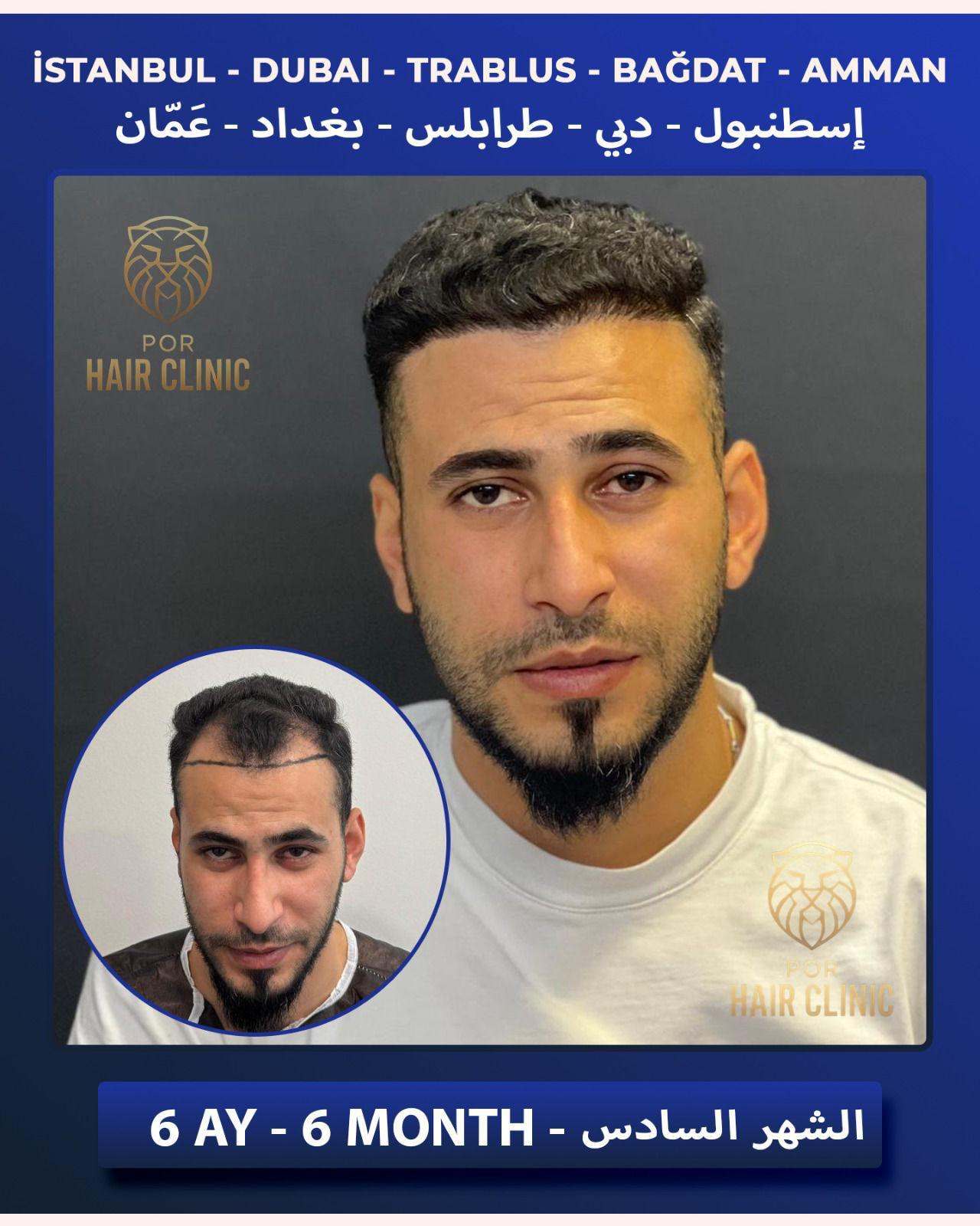 POR Hair Clinic Instagram - saç ekimi paylaşımları