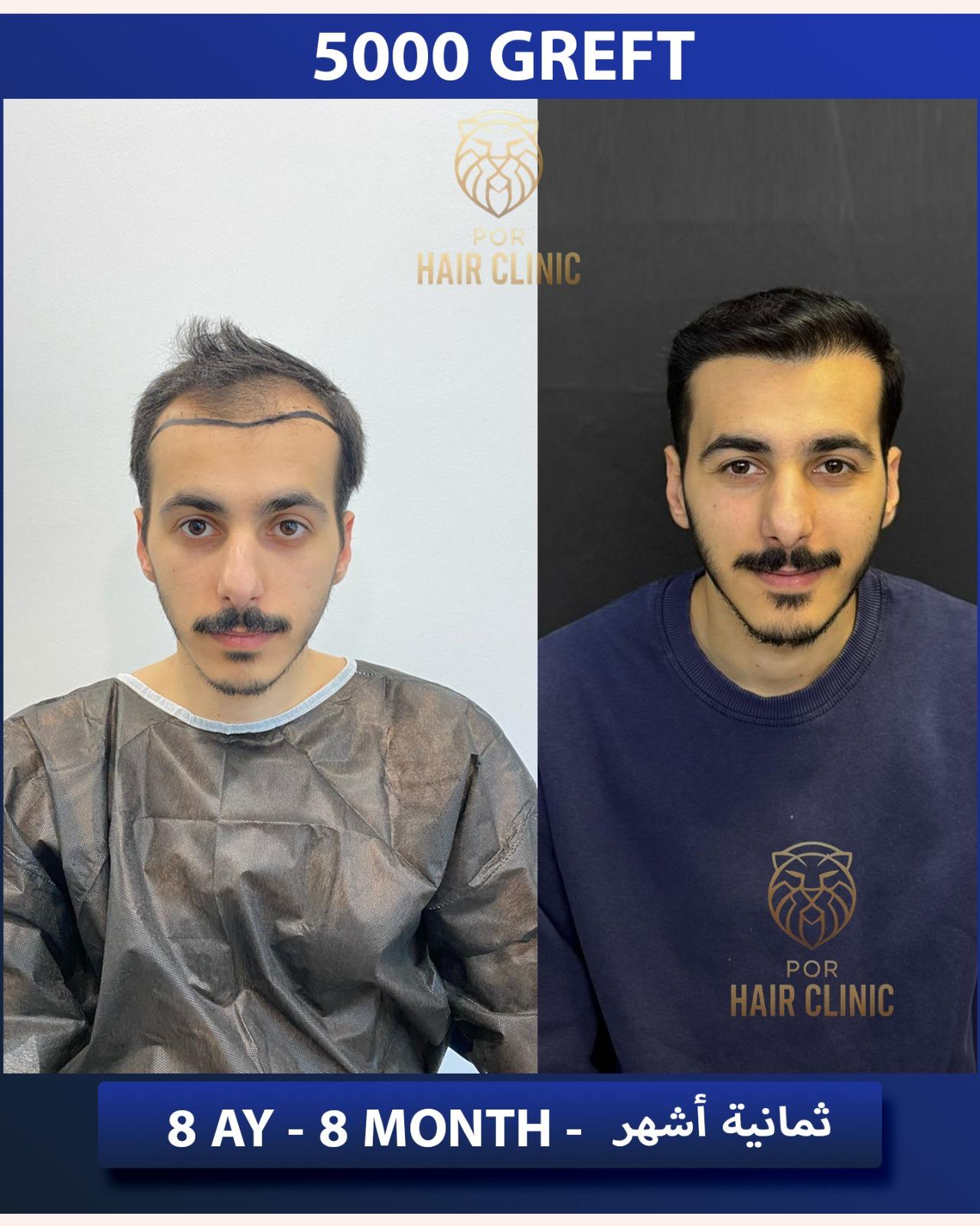 POR Hair Clinic Instagram - saç ekimi paylaşımları