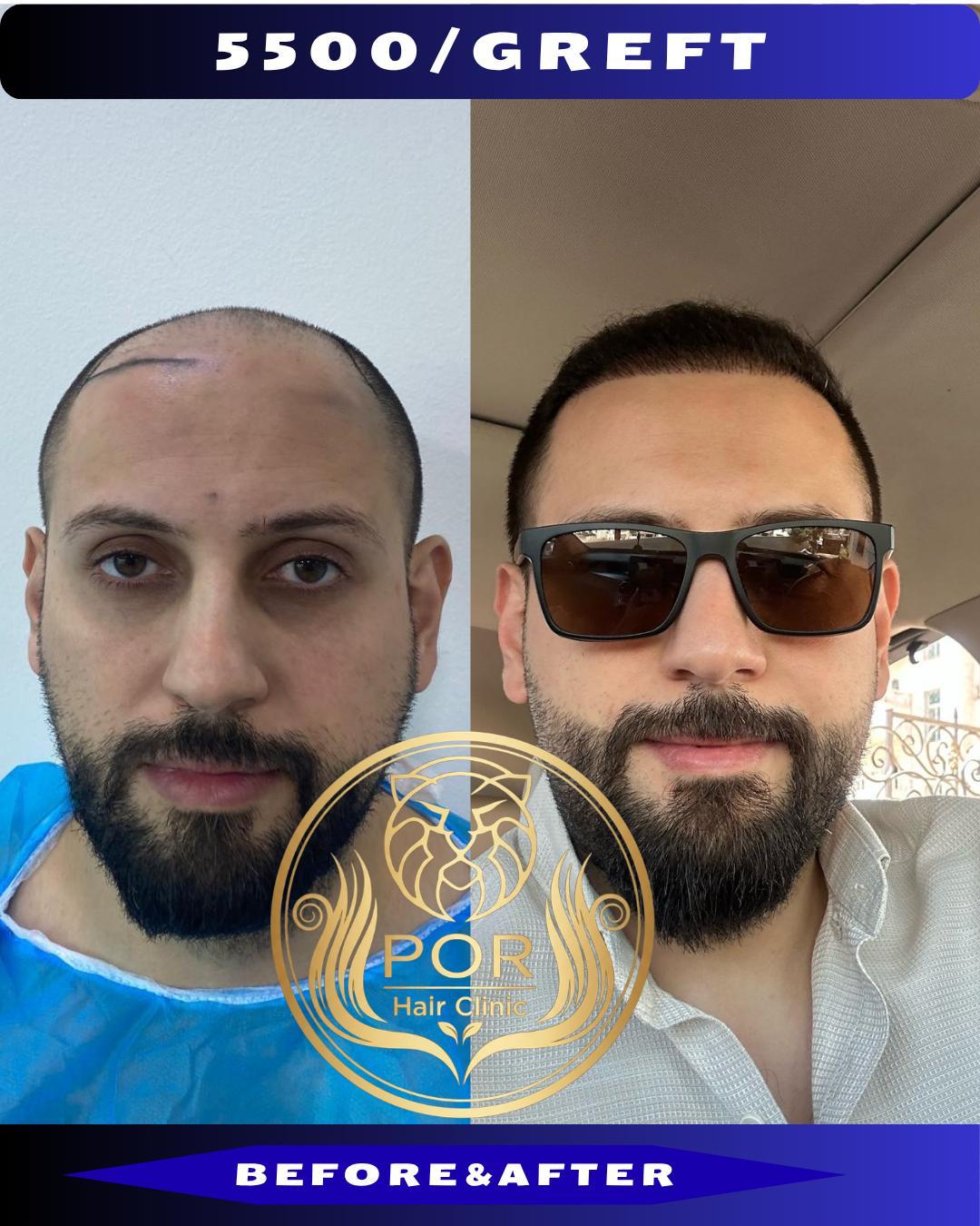 POR Hair Clinic Instagram - saç ekimi paylaşımları