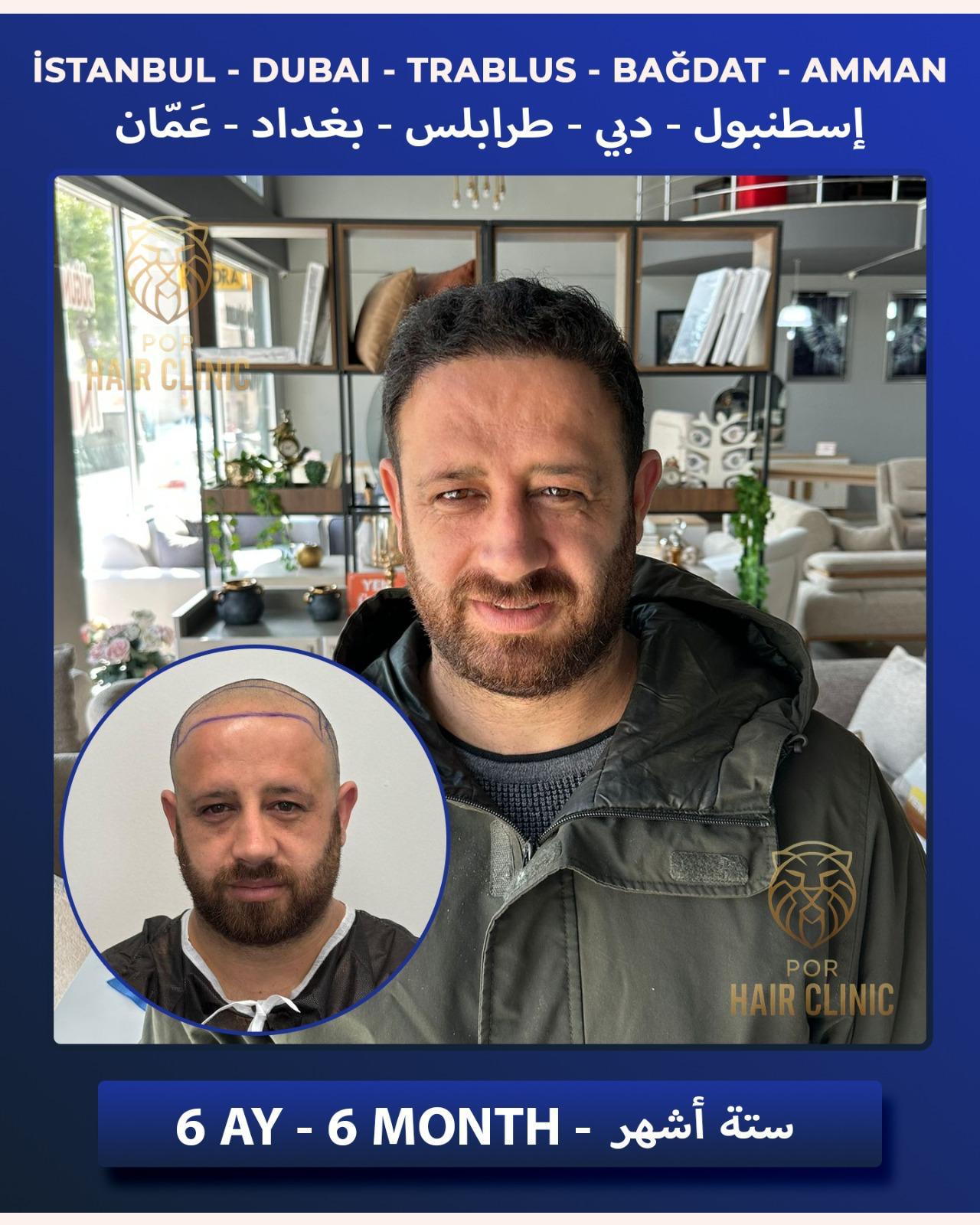 POR Hair Clinic Instagram - saç ekimi paylaşımları