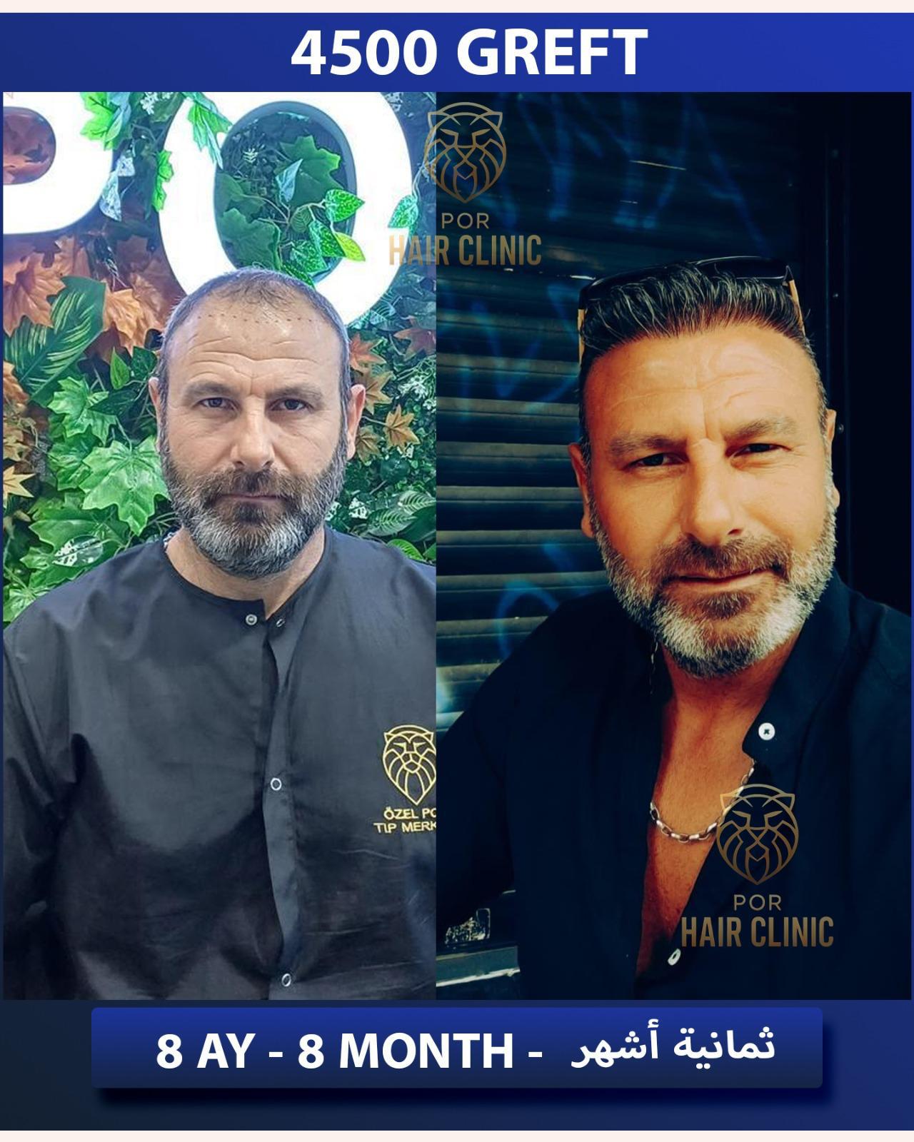 POR Hair Clinic Instagram - saç ekimi paylaşımları