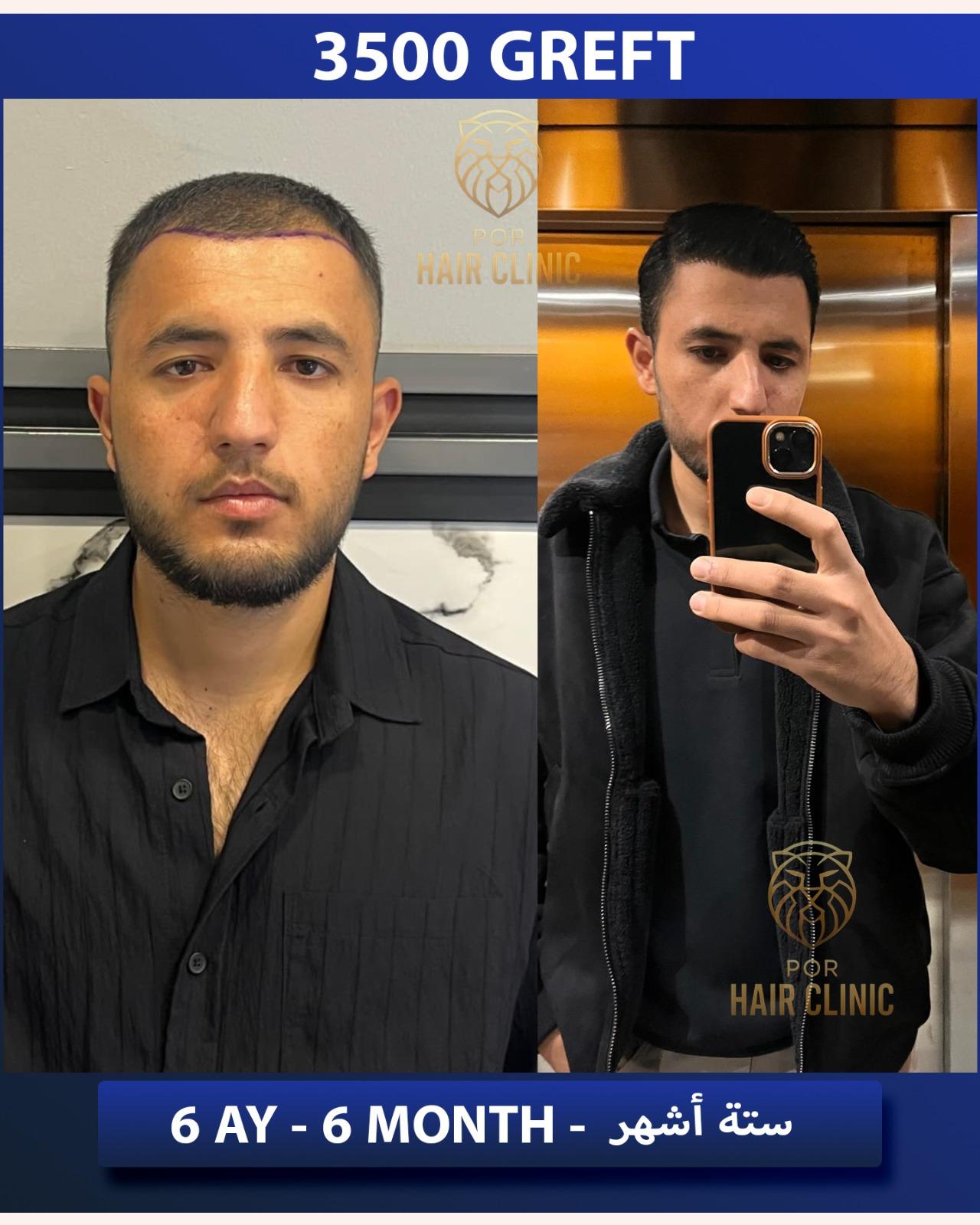 POR Hair Clinic Instagram - saç ekimi paylaşımları