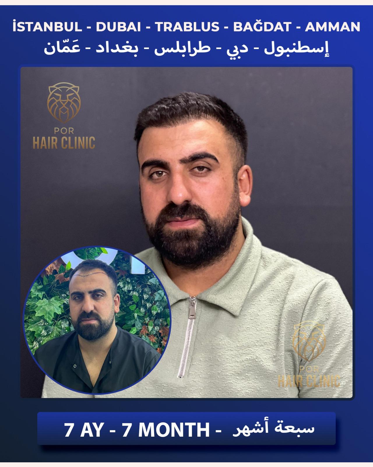 POR Hair Clinic Instagram - saç ekimi paylaşımları