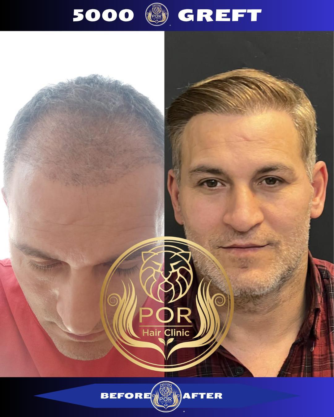 POR Hair Clinic Instagram - saç ekimi paylaşımları