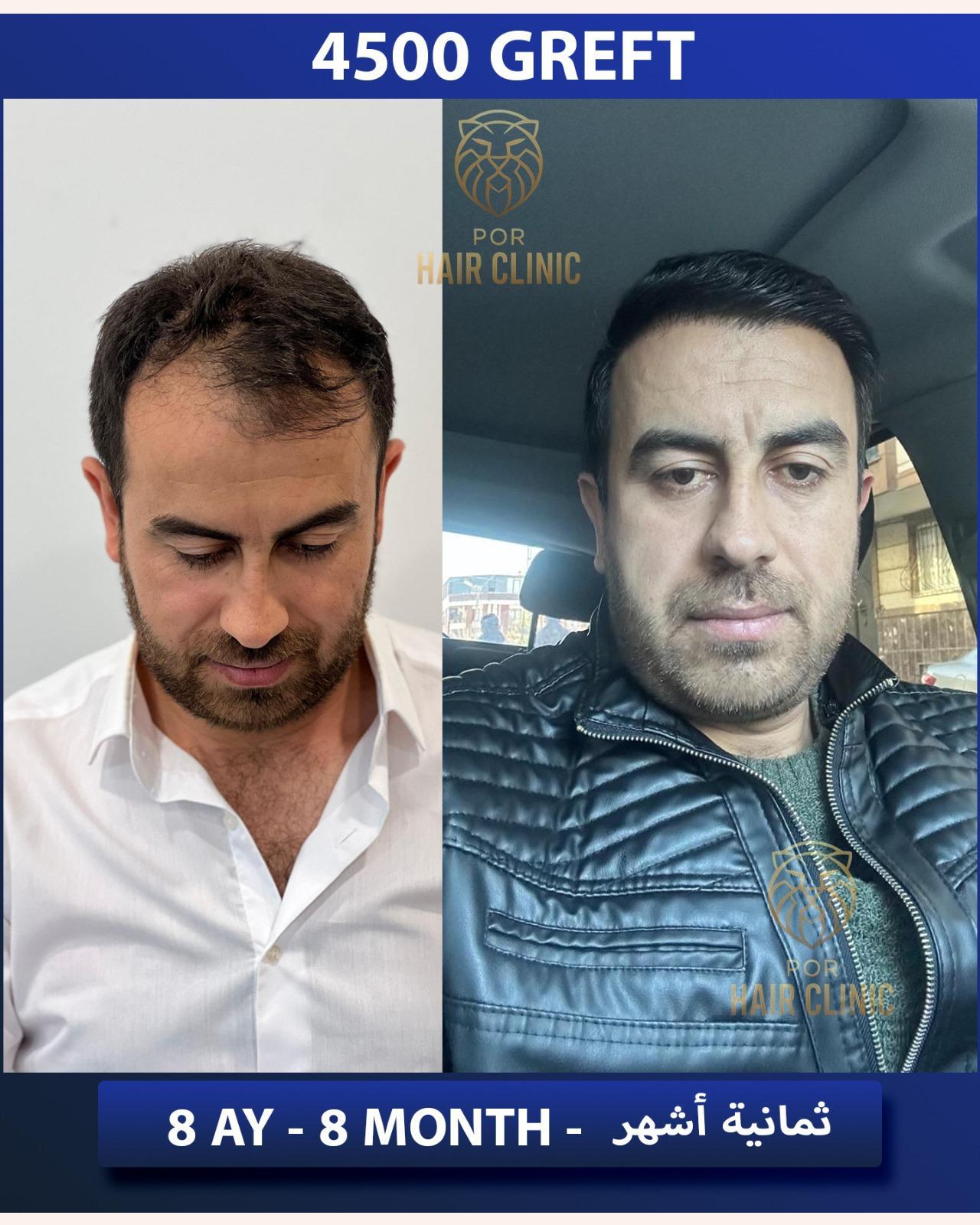 POR Hair Clinic Instagram - saç ekimi paylaşımları