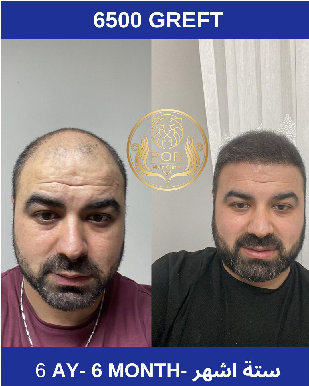 POR Hair Clinic Instagram - saç ekimi paylaşımları