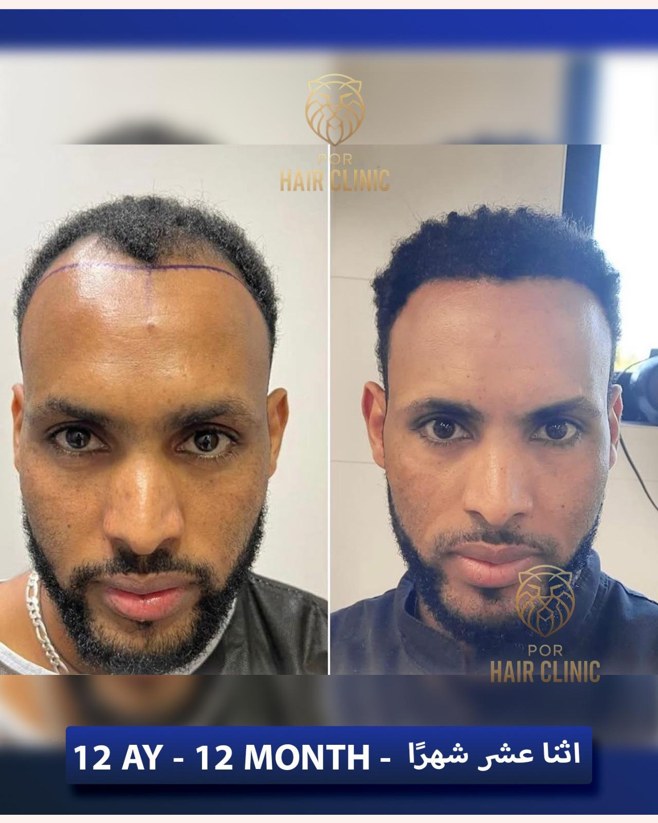 POR Hair Clinic Instagram - saç ekimi paylaşımları