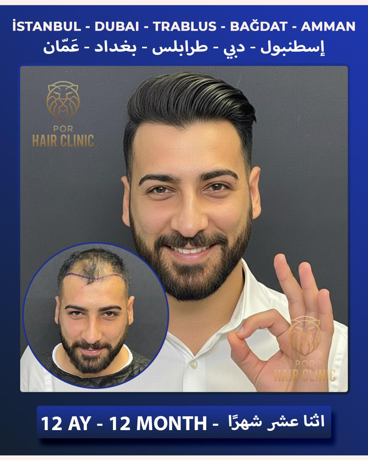 POR Hair Clinic Instagram - saç ekimi paylaşımları