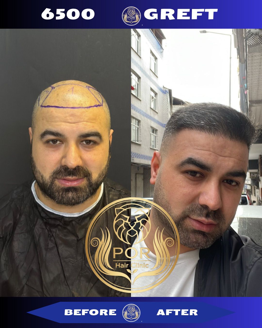 POR Hair Clinic Instagram - saç ekimi paylaşımları